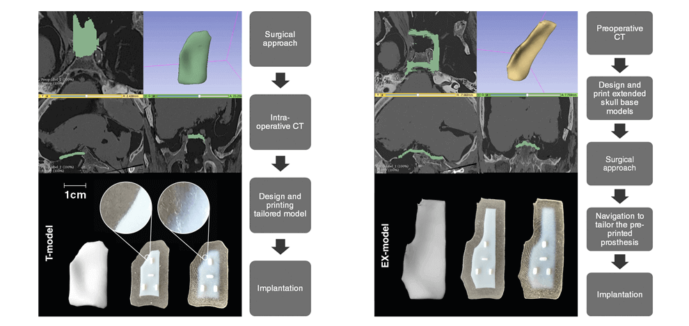 3d-printing-intraoperative-neuronavigation-tailoring-skull-base-reconstruction-after-extended-endoscopic-endonasal-surgery-2 3d-printing-intraoperative-neuronavigation-tailoring-skull-base-reconstruction-after-extended-endoscopic-endonasal-surgery-2